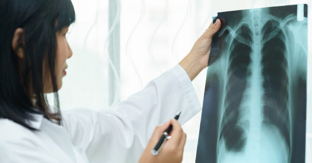 Lung cancer: facts, symptoms, treatment & prevention | Tiq by Etiqa